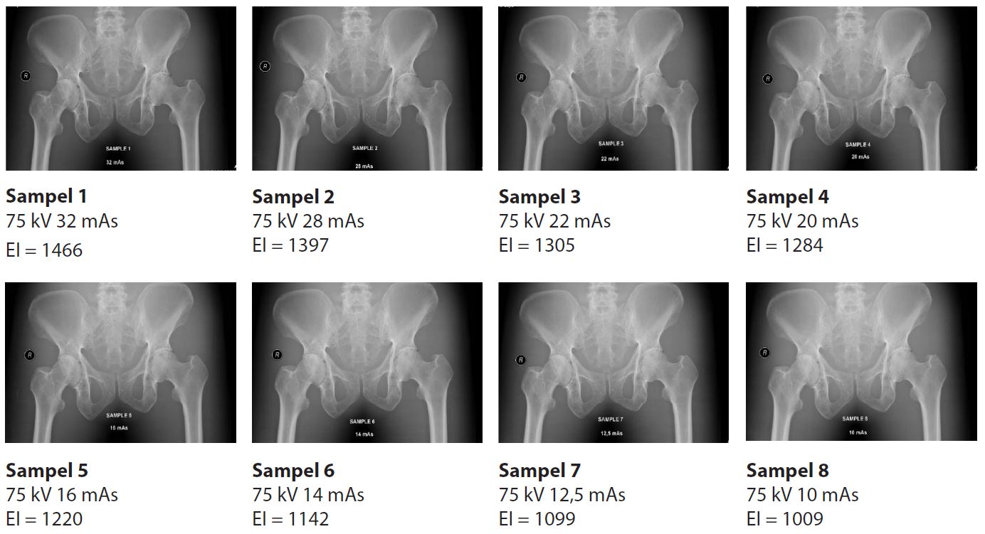 Citra pemeriksaan radiografi pelvis dengan penurunan mAs 15%