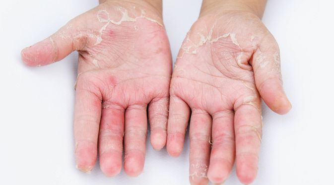 sumber: https://www.ngopibareng.id/read/tips-terhindar-dermatitis-akibat-pemakaian-hand-sanitizer