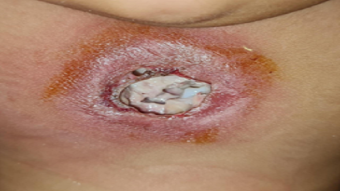 Deep sternal wound infection in a pediatric patient